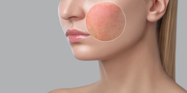 Аллергия на крем для лица: подбираем безопасную альтернативу